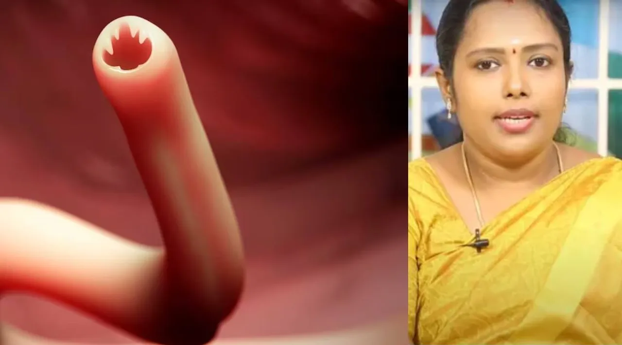 Intestinal worms